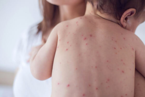 MMR measles vaccine and booster information
