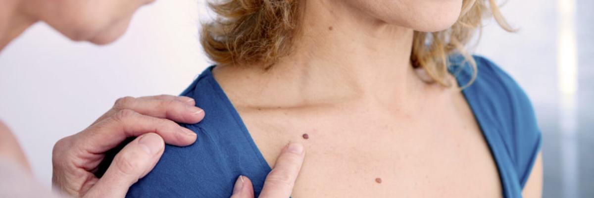 Doctor and woman examining mole on skin, Dermatology